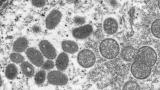 CDC concerned about possible undetected monkeypox spread in U.K.