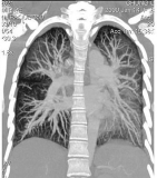UNC Researchers Tackle the E-cigarette or Vaping Product Use–associated Lung Injury (EVALI) Epidemic