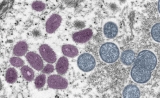 LabCorp will begin testing for monkeypox: CDC announcement