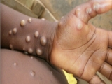 Health News Roundup: N.Korea stockpiled Chinese masks, vaccines before reporting COVID-19 outbreak; Factbox-Monkeypox cases around the world and more