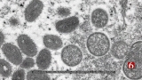 Monkeypox Declared Global Emergency By World Health Organization