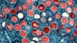 Monkeypox cases rise to 21 in South Carolina: CDC – ABC NEWS 4