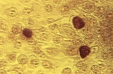 CDC report: STD cases went up during first year of pandemic