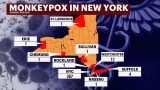New York is ‘epicenter’ of US monkeypox outbreak, more vaccines coming