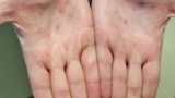 CDC continues to investigate possible monkeypox case in DC resident. Here's what we know – WJLA