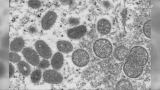 CDC report shows racial disparities in monkeypox cases