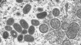 WHO to decide on sounding highest alarm on monkeypox