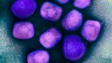 A monkeypox epidemic may be here. The U.S. isn’t ready for it