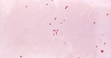 CDC acknowledges “outbreak” of meningococcal disease in Florida
