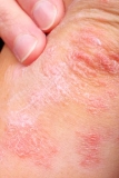 Examining Modifiable Risk Factors in Psoriasis