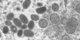 Here’s How the US Handled Its First-Ever Monkeypox Outbreak