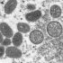 Monkeypox: What to know about the virus detected in the United States