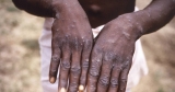 Monkeypox may be mistaken for a STD, warns CDC; current outbreak stemmed from 2 raves in Europe – New York Daily News