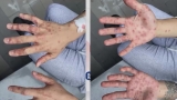 CDC to ramp up monkeypox response, provide more vaccines