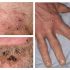 WHO says monkeypox does not constitute a global public health emergency