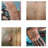 Michigan doesn’t have any doses of vaccine used to prevent monkeypox