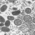 Minnesota reports first case of monkeypox