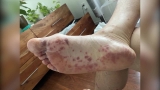 White House, CDC take steps to deal with monkeypox outbreak as W.H.O declares public health emergency