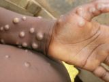 Monkeypox virus: Know what it is, how it spreads, what causes it