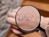 Explainer: Who are more at risk of contracting monkeypox?