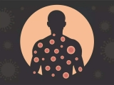 Monkeypox not as alarming as COVID, but here’s how you can prevent it
