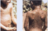 Monkeypox is in Texas, here’s what you need to know about it
