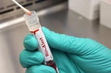 First cases of monkeypox in children in U.S. confirmed
