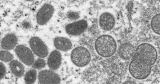 Australia says man returned from Europe probably has monkeypox | Health News