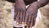 Monkeypox outbreak: Did end of smallpox vaccination help monkeypox spread?