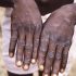 CDC suggests indoor masking for South Florida – WEAR