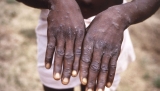 Utah has more monkeypox cases, but CDC, state, disagree on how many