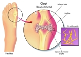 What Are The Warning Signs Of Gout?