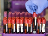 New test may detect disease years before symptoms emerge
