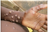 Britain lists monkeypox as notifiable infectious disease