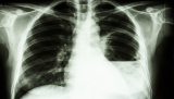 Uncommon bacteria found in Gulf area by Mississippi-CDC investigation