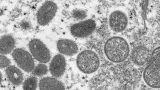 Monkeypox case reported in Virginia, CDC says