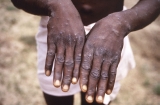 Two new monkeypox cases found in Massachusetts