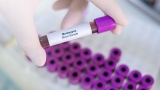 Monkeypox cases in US fall, hit lowest level since June: CDC