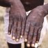 The monkeypox outbreak was predicted by a Nigerian doctor years ago : Goats and Soda – NPR