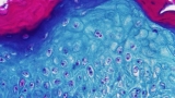 CDC confirms new cases as outbreak continues