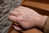 First Case Of Monkeypox Confirmed In Camden County By CDC, Health Department Says – CBS Philly