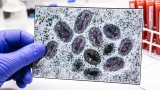Monkeypox Outbreaks Stir Fear of a New Pandemic. How Worried Should We Be?