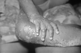 CDC now monitoring ‘over 200 individuals in 27 states’ for monkeypox