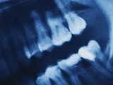 COVID-19 (coronavirus) and teeth: Is there a connection?