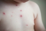 Monkeypox case in child pending CDC confirmation