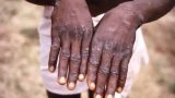 World Health Network declares Monkeypox a pandemic
