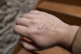 Monkeypox explained | News