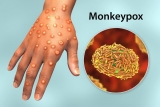 CDC experts update on monkeypox in the United States