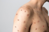 CDC report shows people with monkeypox have higher than expected rates of HIV and STIs