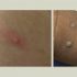 Two San Diego County residents test positive for monkeypox, the region’s first cases